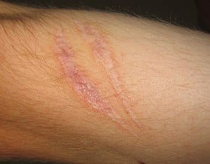 How to Remove Scars on Legs? Treatment & Laser Price Reviews in Singapore
