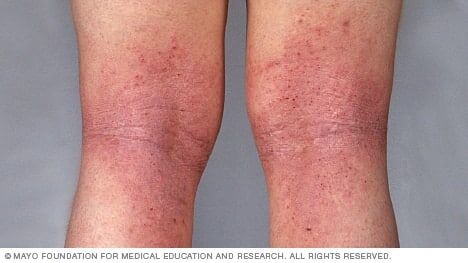 can glutathione remove leg scars Laser Treatment For On Legs In Dubai, Abu Dhabi & Sharjah Laser Stretch Mark & Scar